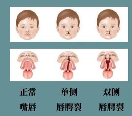 口腔微生物与唇腭裂及唇腭裂患者易感疾病有何关联（一）